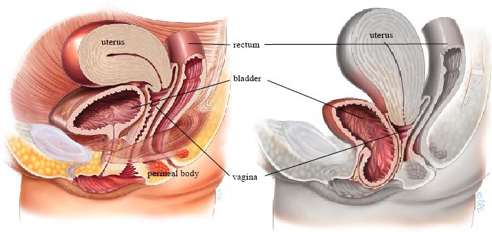 Prolapsed Bladder (Cystocele) Surgical Repair with a Vaginal Slin