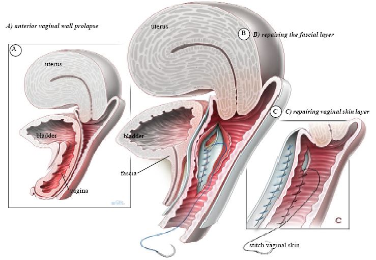 Anterior Vaginal Repair Your Pelvic Floor