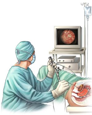 During cystoscopy the images that the doctor sees may be displayed on a TV monitor.