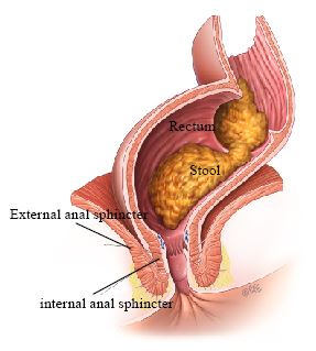 Faecal incontinence, soiling or encopresis