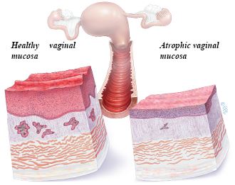 Vaginal Changes - Therapies for Vaginal Dryness and Urine Leakage