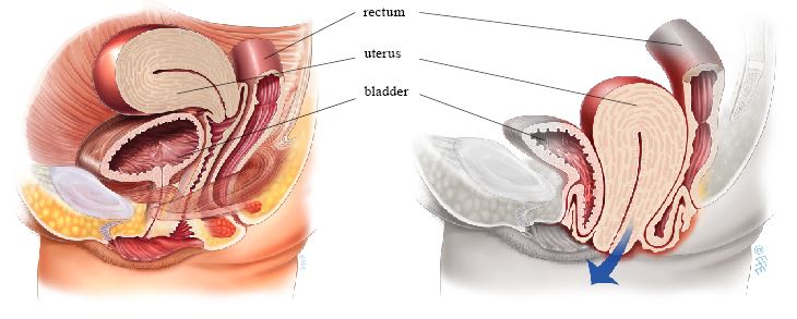 uterine prolapse, prolapsed uterus, uterine prolapsed causes, uterine  prolapse symptoms, uterine prolapse treatment