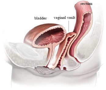 Vaginal Hysterectomy for Uterine Prolapse and Vaginal Repair - Milton  Keynes University Hospital